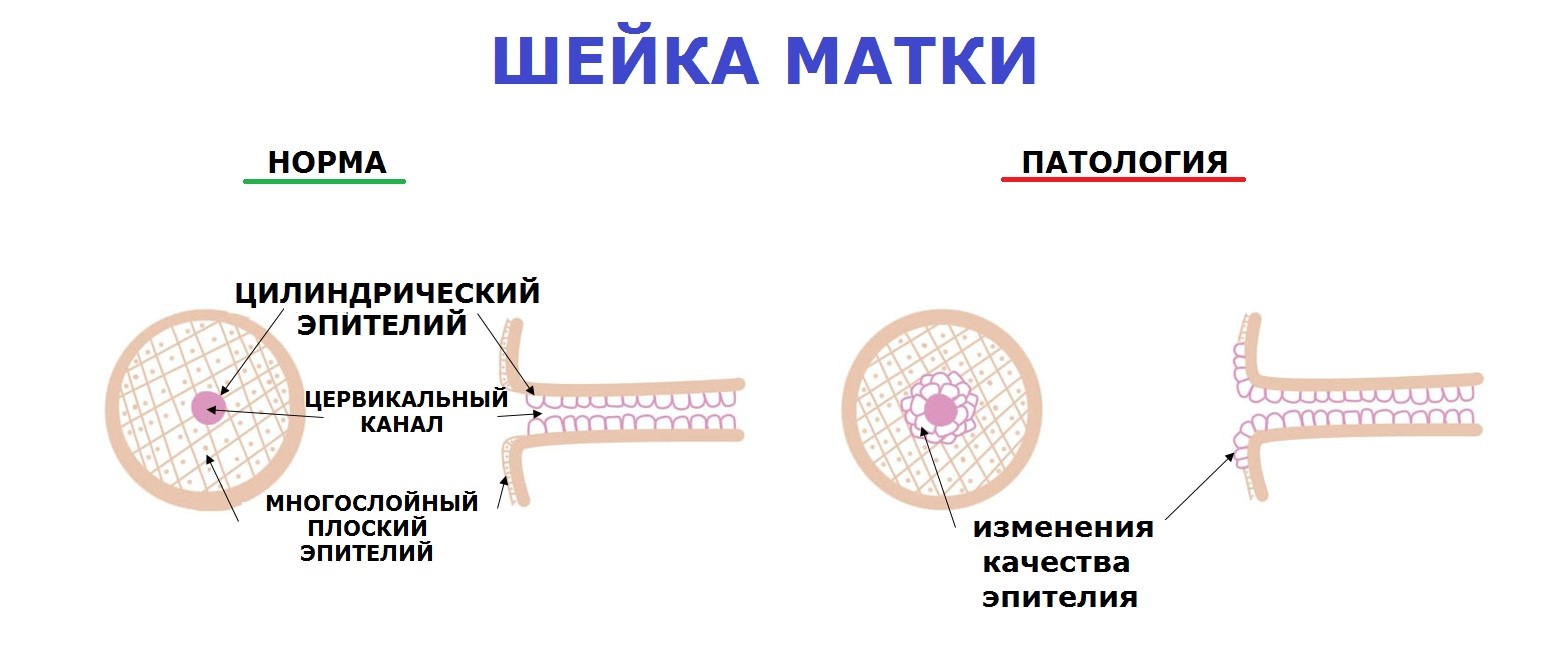 Рак шейки матки, стадии, причины, симптомы, лечение