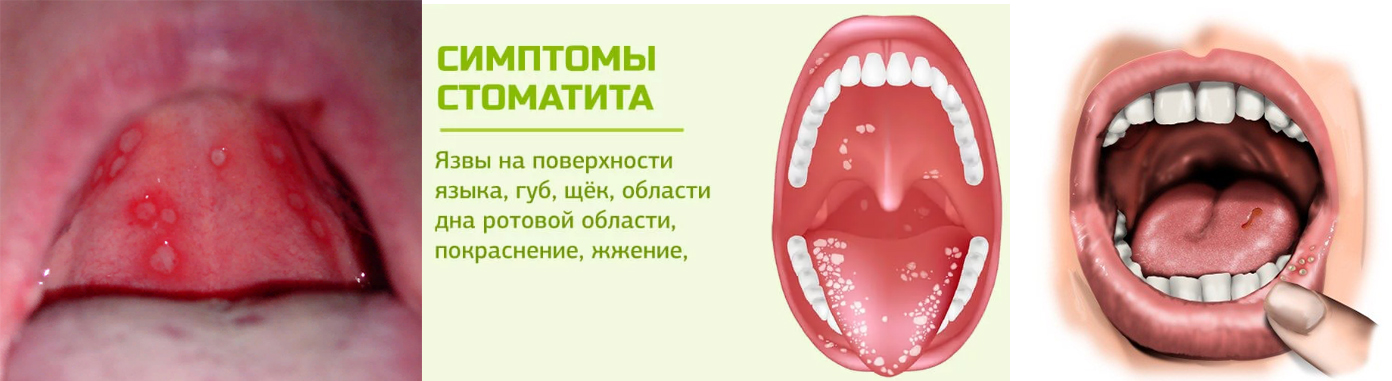 Препараты для анестезии в стоматологии